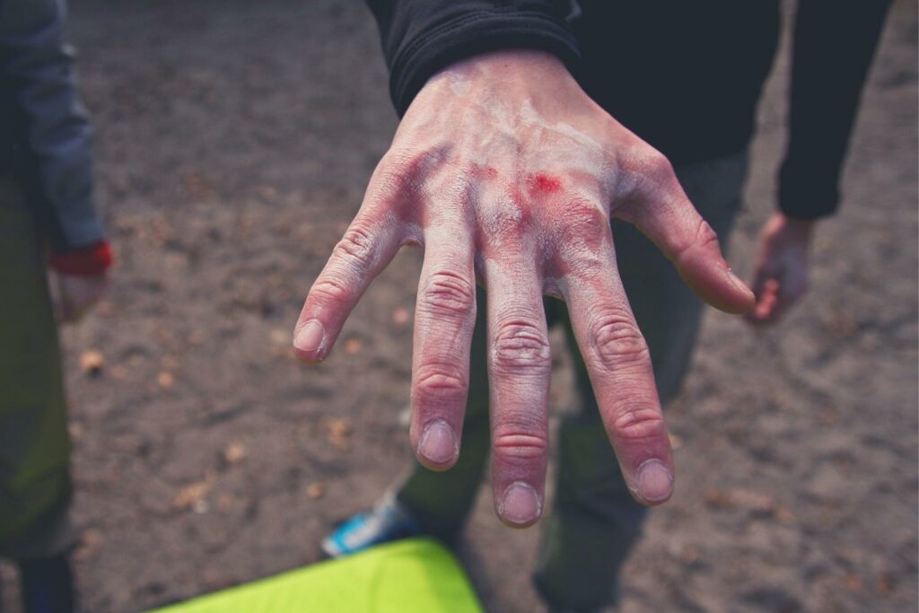 skin damaged climbing hands